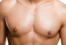 بروز الثدي عند الرجال