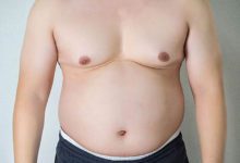 علاج ترهل الثدي عند الرجال