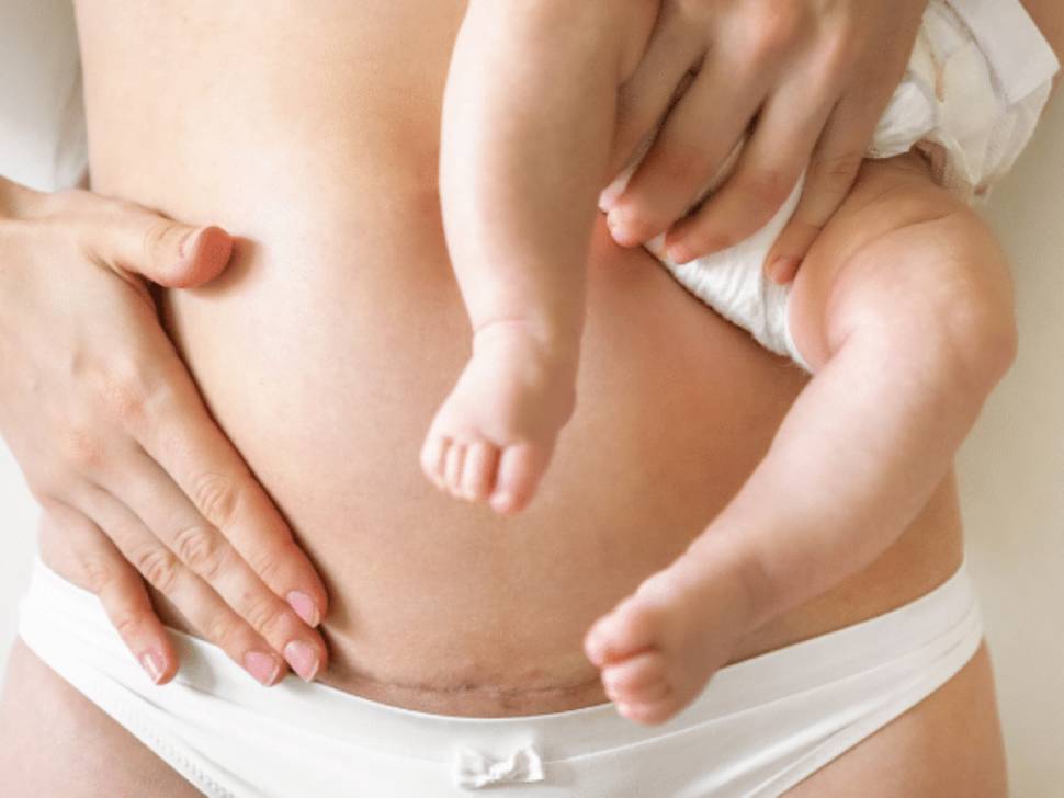 شفط دهون البطن أثناء الولاده القيصرية